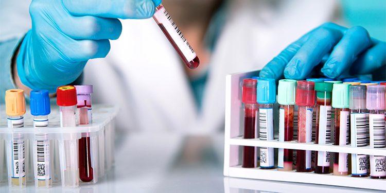 Cómo identificar los niveles altos de colesterol en sangre sin análisis