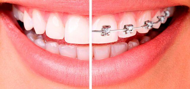 ¿Cuáles son los beneficios para la salud de los tratamientos de ortodoncia?